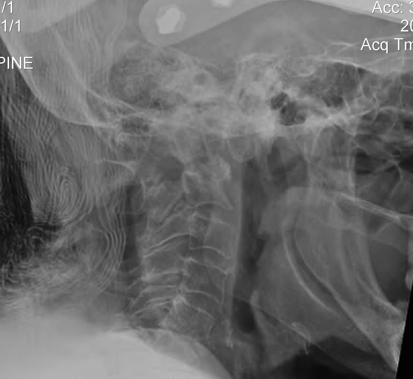 Superior Migration Ondontoid Lateral Xray